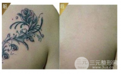 激光洗纹身的果怎么样？会不会留疤？