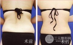 韩式分层吸脂的果怎么样？有哪些优势？