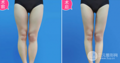 大腿吸脂的术前术后注意事项以及禁忌人群