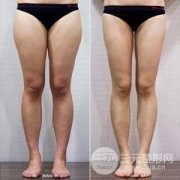 大腿水动力环形吸脂的果怎么样？要吸多少次？多少钱？