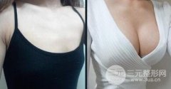 自体脂肪隆胸抽哪里的脂肪比较好？