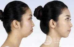 自体脂肪垫下巴降低风险吗？