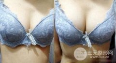 自体脂肪隆胸有哪些优点？