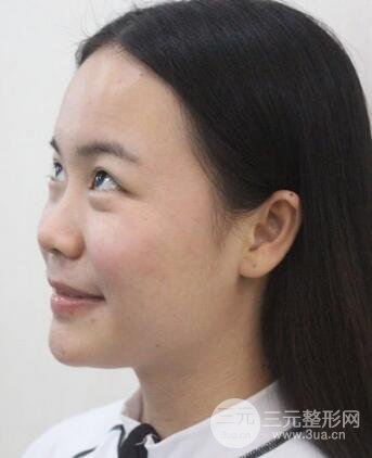 假体隆鼻恢复过程实例 前后果对比