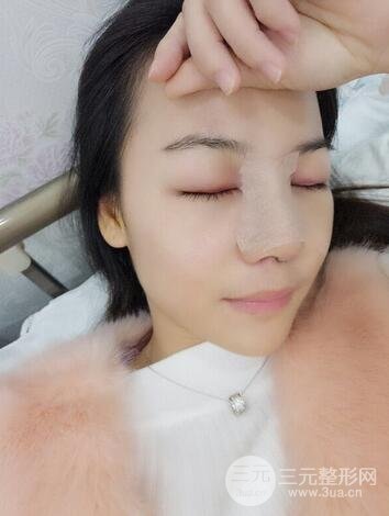 假体隆鼻恢复过程实例 前后果对比