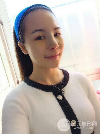 假体隆鼻恢复过程实例 前后果对比