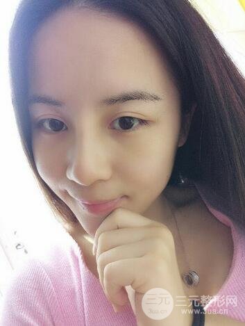 假体隆鼻恢复过程实例 前后果对比