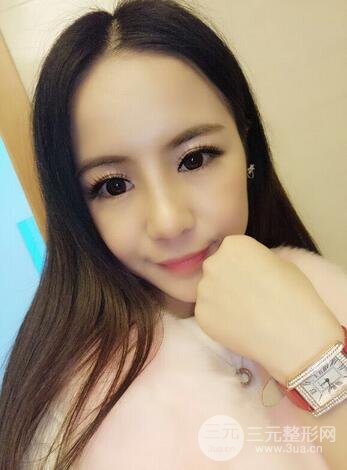 假体隆鼻恢复过程实例 前后果对比