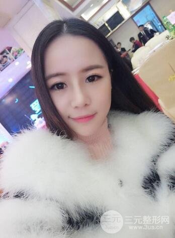 假体隆鼻恢复过程实例 前后果对比