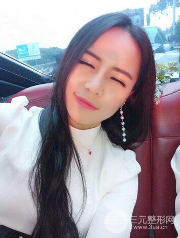 假体隆鼻恢复过程实例 前后果对比