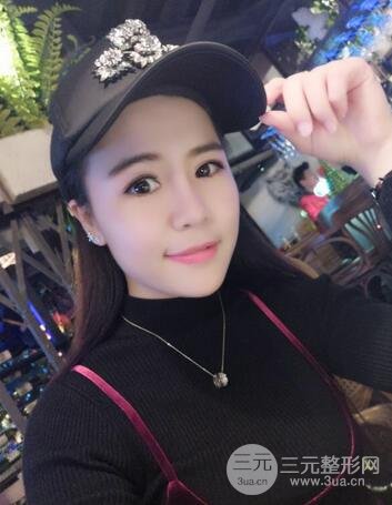 假体隆鼻恢复过程实例 前后果对比