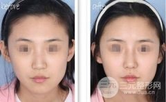 注射隆鼻失败后怎么办，怎么修复