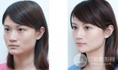 注射乔雅登隆鼻怎么样、有什么优势