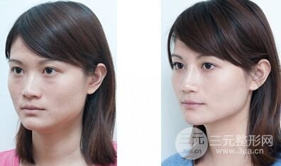 注射乔雅登隆鼻怎么样、有什么优势