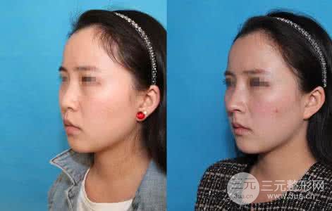 假体隆鼻术后多久可以取出,取出难度高吗