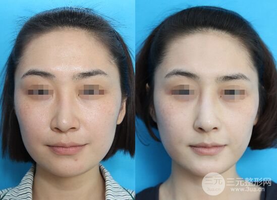 膨体隆鼻失败后取出需要多久恢复