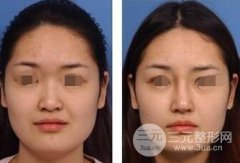 注射隆鼻可靠性怎么样，会失败吗