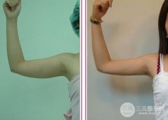 手臂吸脂果怎么样、有什么优势