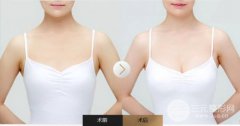 成都做自体脂肪隆胸手术的价格