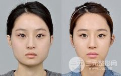 下颌角整形贵不贵？北京下颌角整形多少钱？