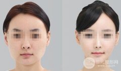 下颌角整形手术过程是怎样的？