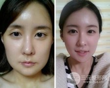 下颌角整形过后需要住院几天？恢复起来快吗？