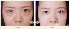 眼部整形去眼袋手术有哪些?失败后遗症和术后护理有哪些?