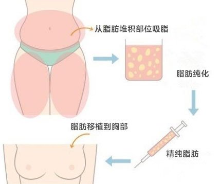 自体脂肪丰胸