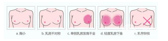 自体脂肪丰胸适宜人群