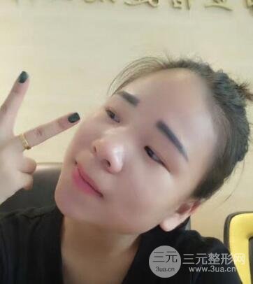 韩式生科隆鼻图片 深圳丽港丽格隆鼻整形归来