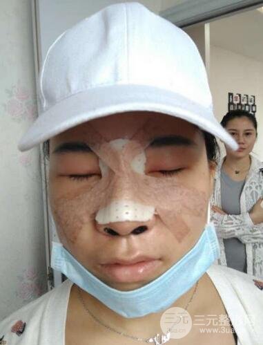 韩式生科隆鼻图片 深圳丽港丽格隆鼻整形归来