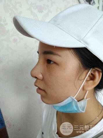 韩式生科隆鼻图片 深圳丽港丽格隆鼻整形归来