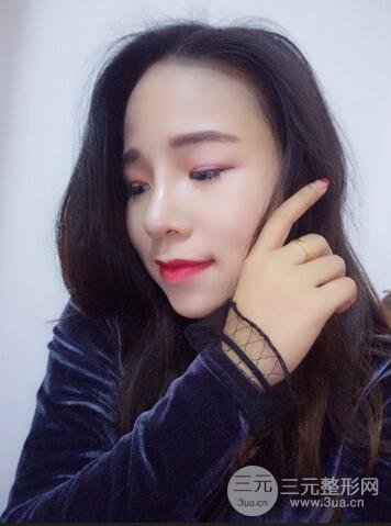 韩式生科隆鼻图片 深圳丽港丽格隆鼻整形归来