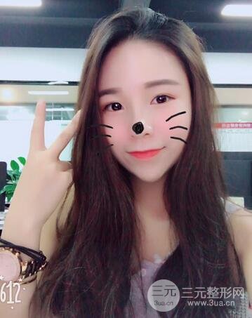 韩式生科隆鼻图片 深圳丽港丽格隆鼻整形归来