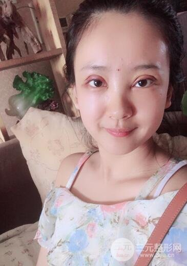 割双眼皮果展示 丽港丽格割双眼皮恢复过程图