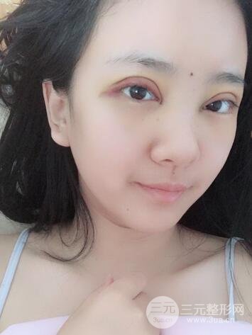 割双眼皮果展示 丽港丽格割双眼皮恢复过程图