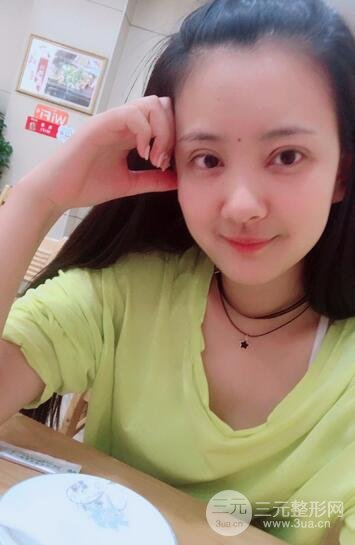 割双眼皮果展示 丽港丽格割双眼皮恢复过程图