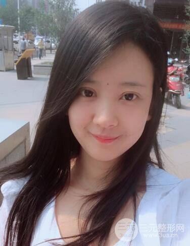 割双眼皮果展示 丽港丽格割双眼皮恢复过程图