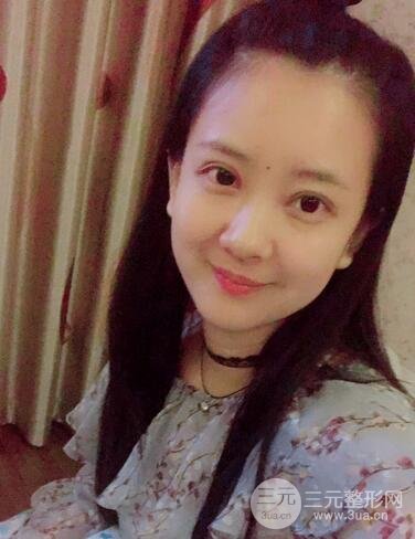 割双眼皮果展示 丽港丽格割双眼皮恢复过程图