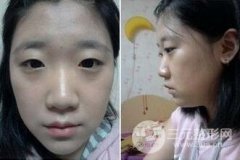 隆鼻+双眼皮真实案例图片分享 变美就这么简单 隆鼻+双眼皮真实案例图片分享 变美就这么简单
