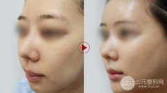 口唇整形厚唇修薄术有哪些注意事项?手术优点有哪些?