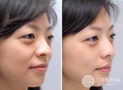 口唇整形厚唇修薄术有风险较低（不代表没有风险）?果怎么样?