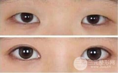 眼部整形开眼角手术会反弹吗？