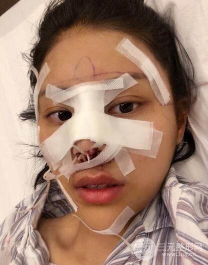 膨体隆鼻隆鼻整形前后对比 重庆军美鼻部整形