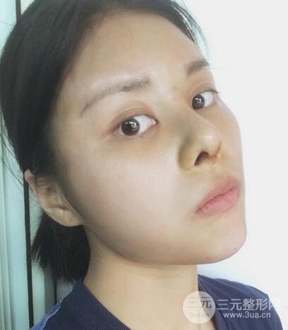 膨体隆鼻隆鼻整形前后对比 重庆军美鼻部整形
