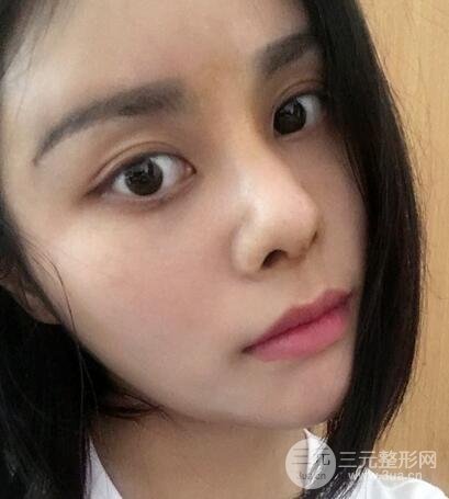 膨体隆鼻隆鼻整形前后对比 重庆军美鼻部整形