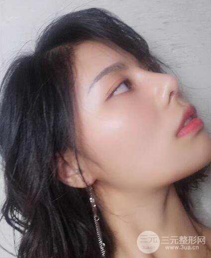 膨体隆鼻隆鼻整形前后对比 重庆军美鼻部整形