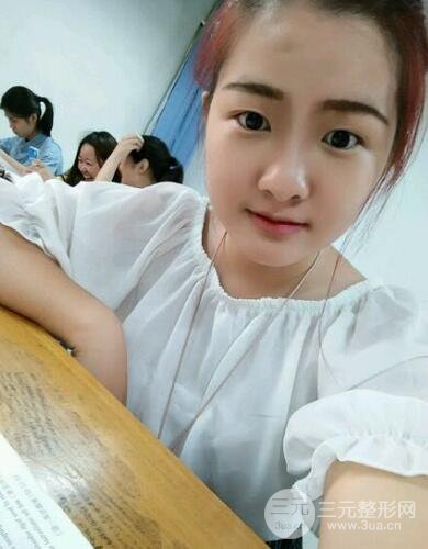切开双眼皮开眼角恢复过程图 前后果对比