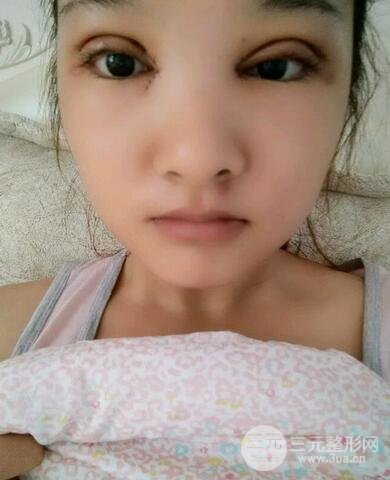 切开双眼皮开眼角恢复过程图 前后果对比
