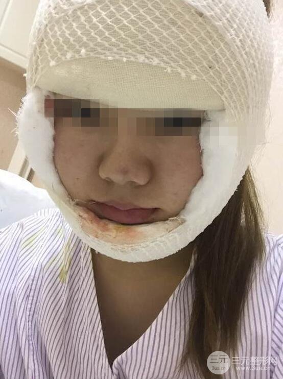 削骨前后对比图 恢复效果分享